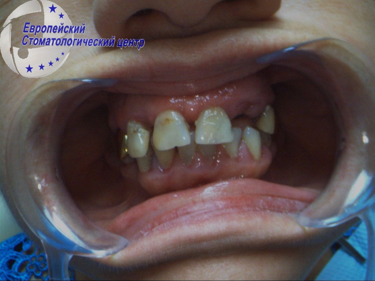 implantacija 15
