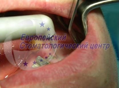 implantacija 1