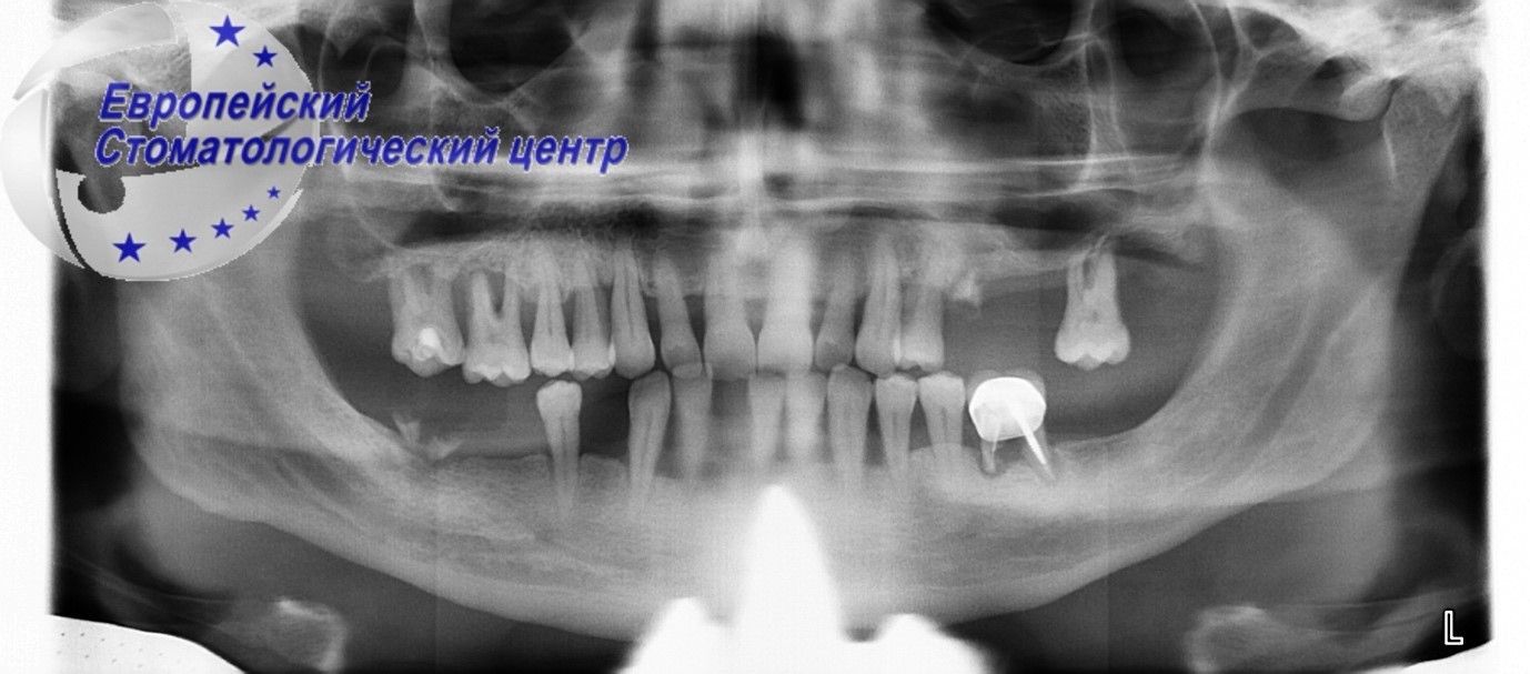 implantacija 10