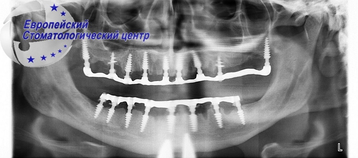 implantacija 12