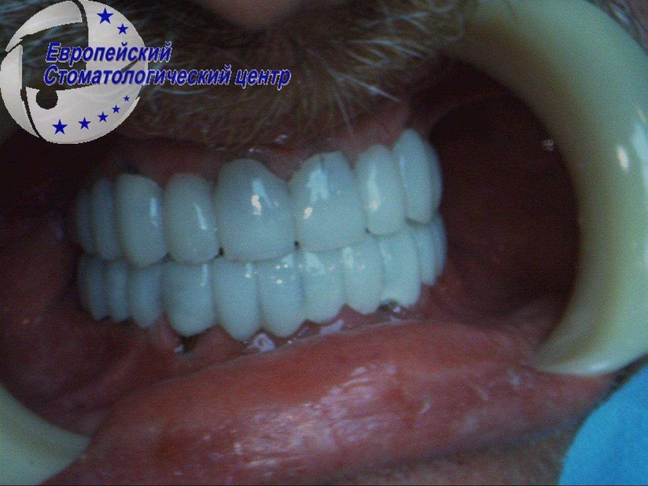implatacija 13