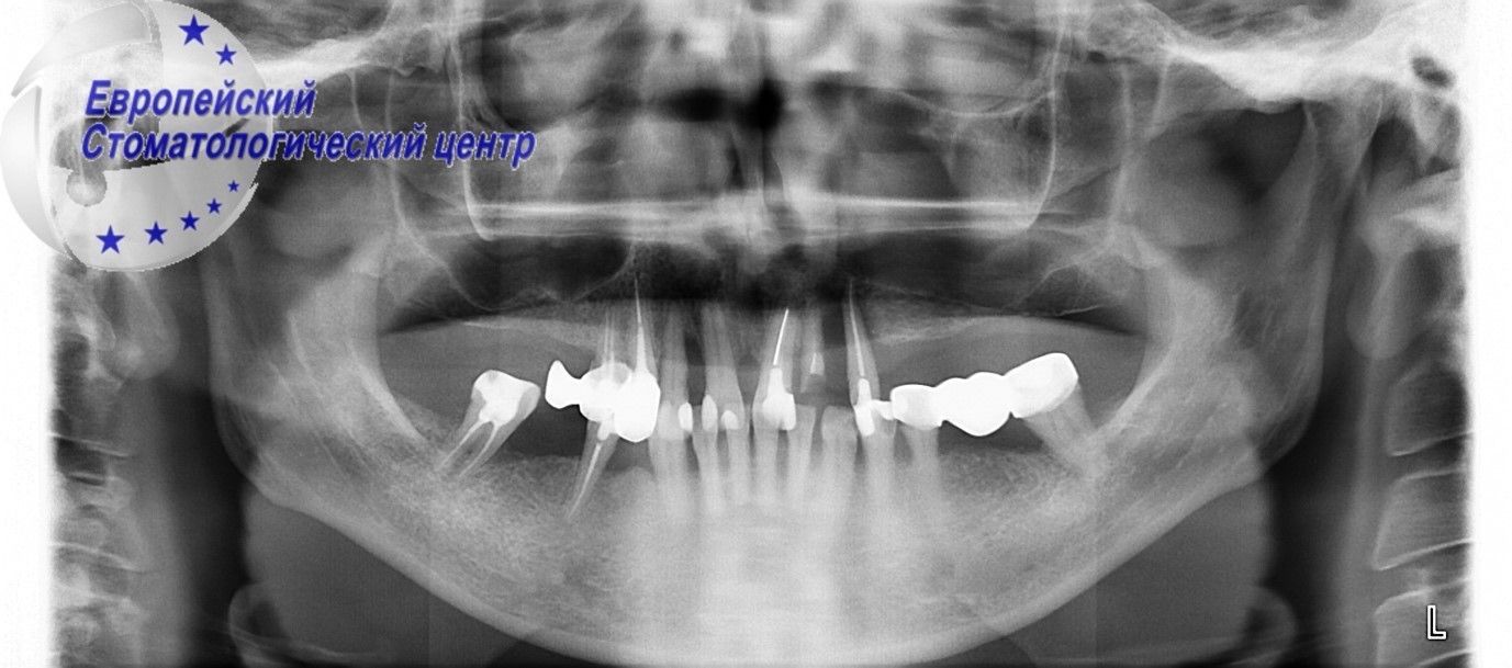 implantcija 14