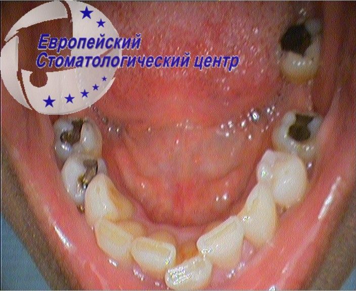 implantacija 15e
