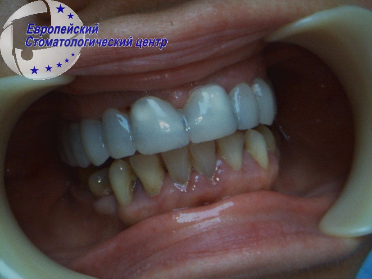 implantacija 17