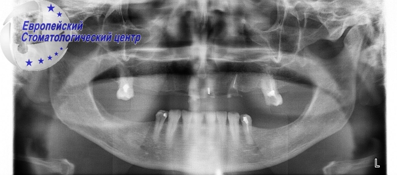 implantacija 2