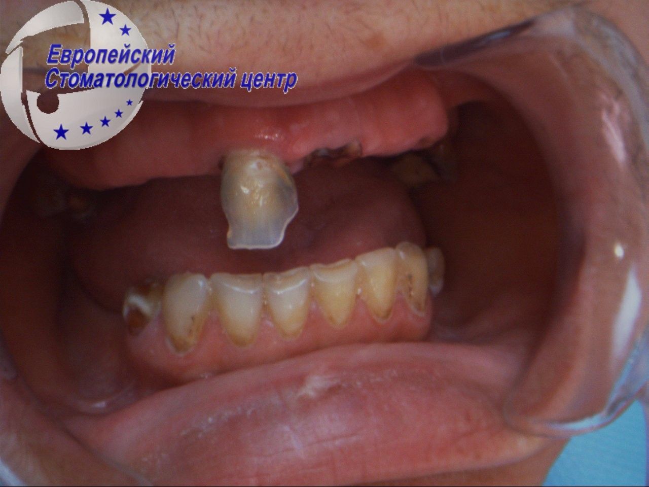 implantacija 3