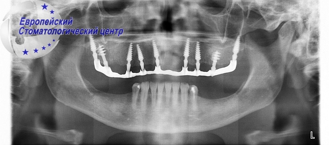 implantacija 4