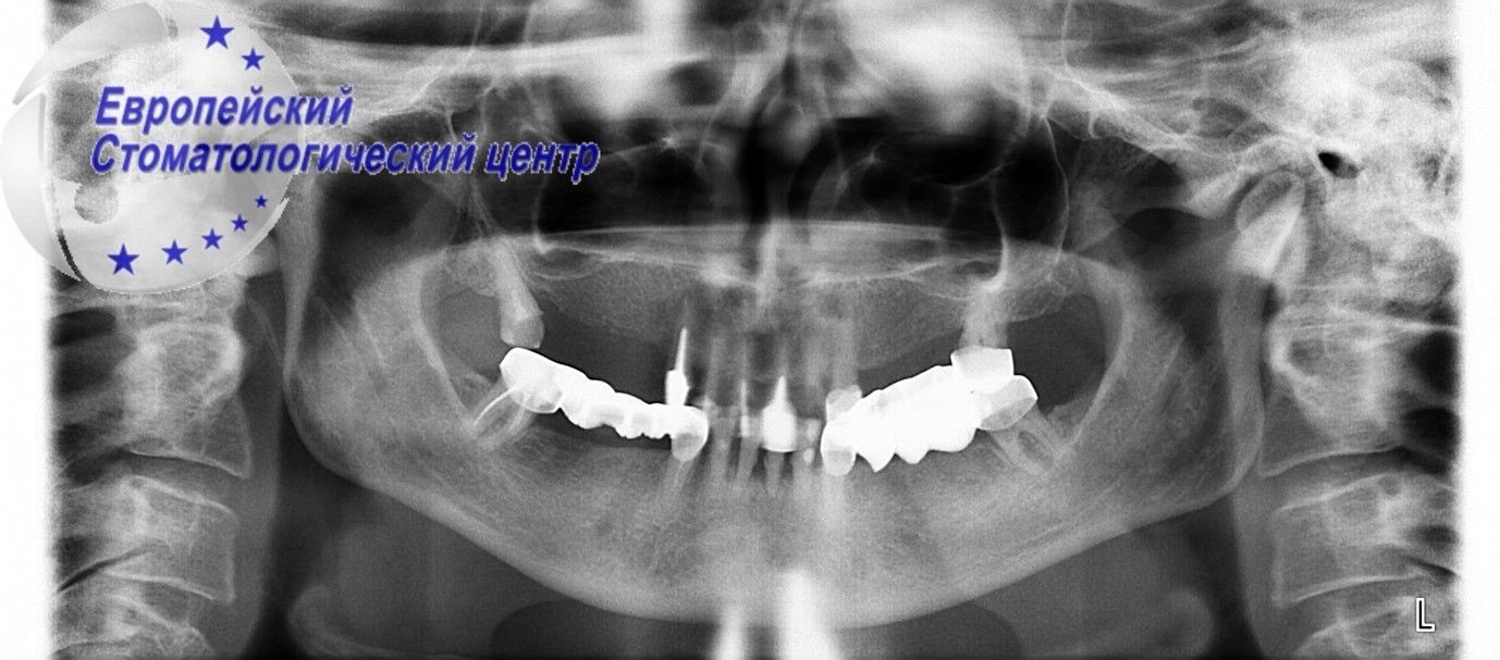implantacuja 6