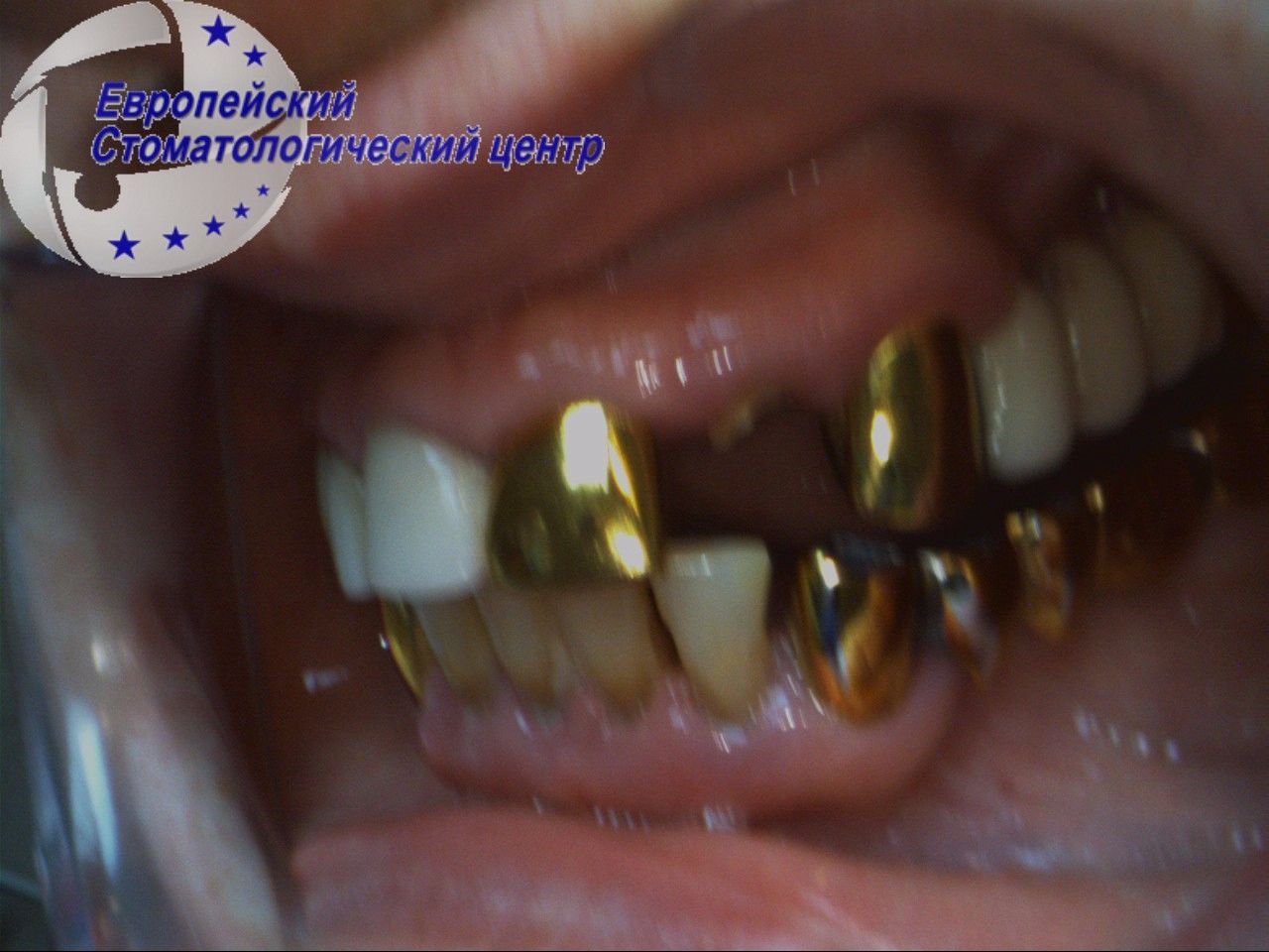 implantacija7