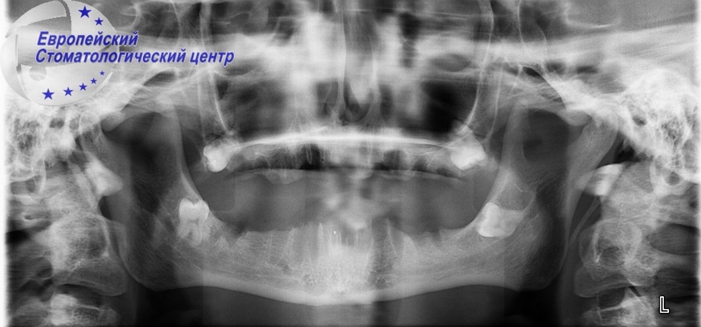 implantacija 10k