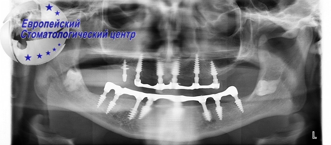 implantacija 11k
