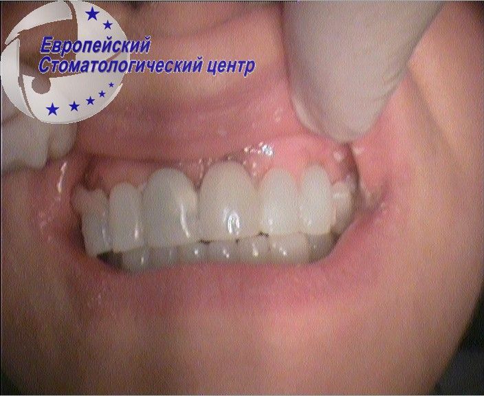 implantacija 12k