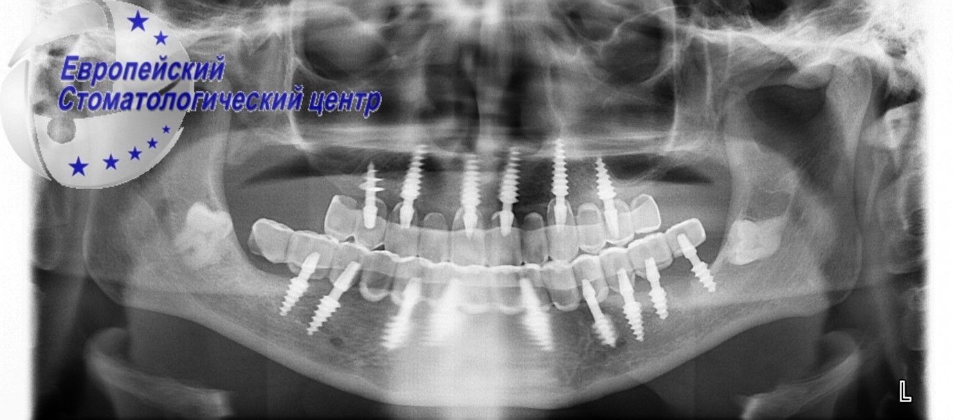 implantacija 13k