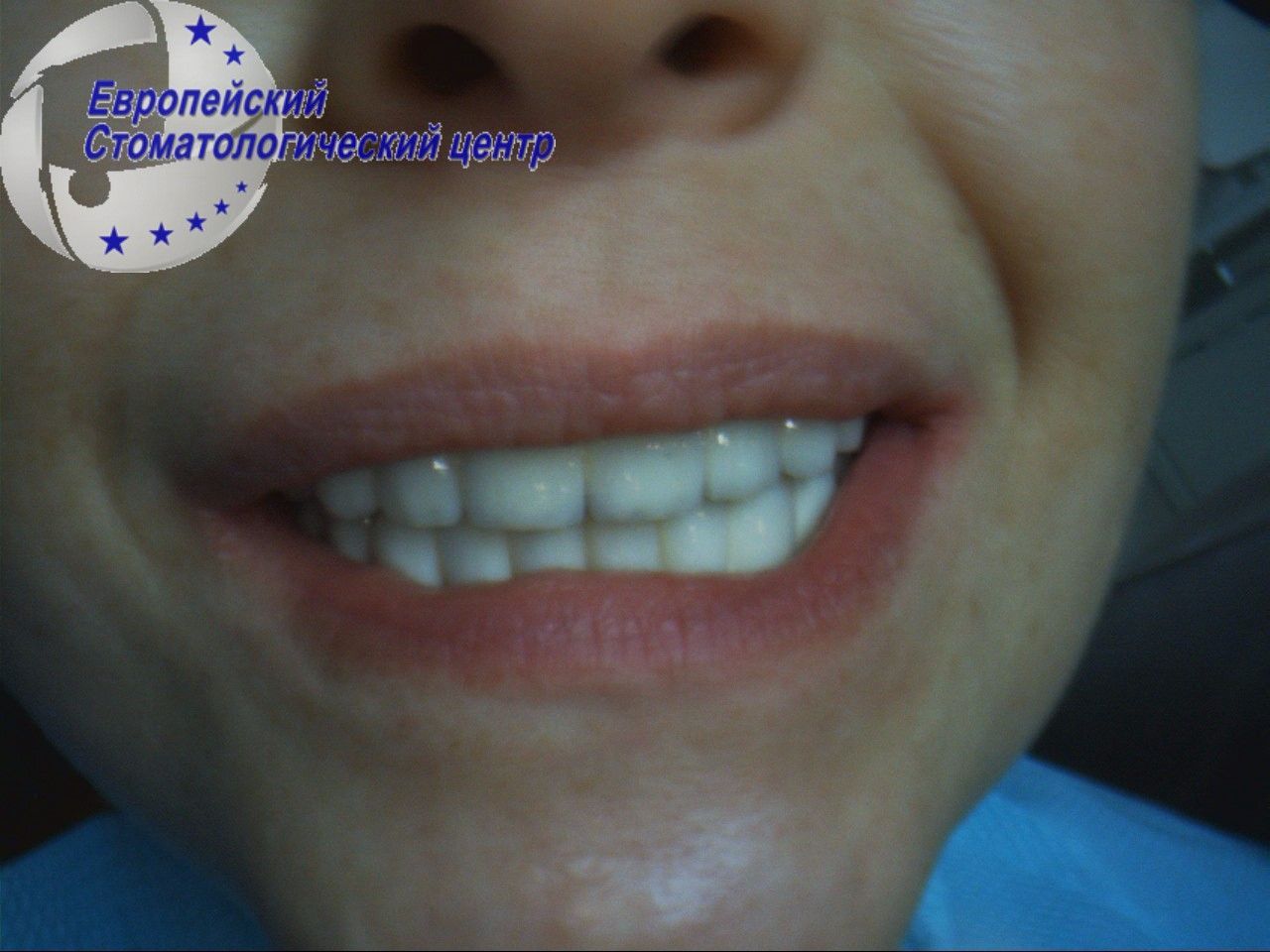 implantacija 14k