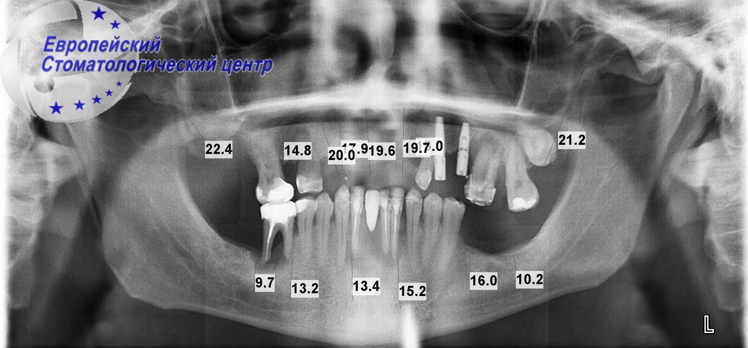 implantacija 1k