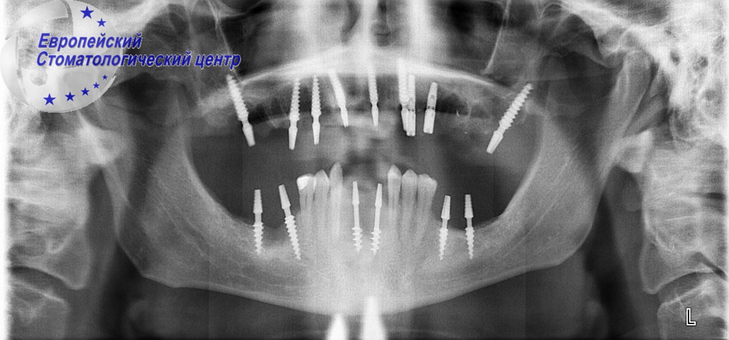 implantacija 2k