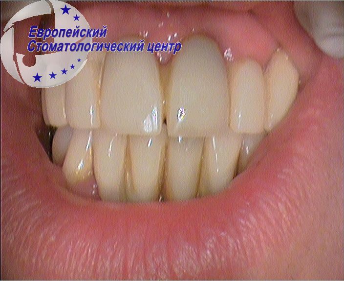 implantacija 3k
