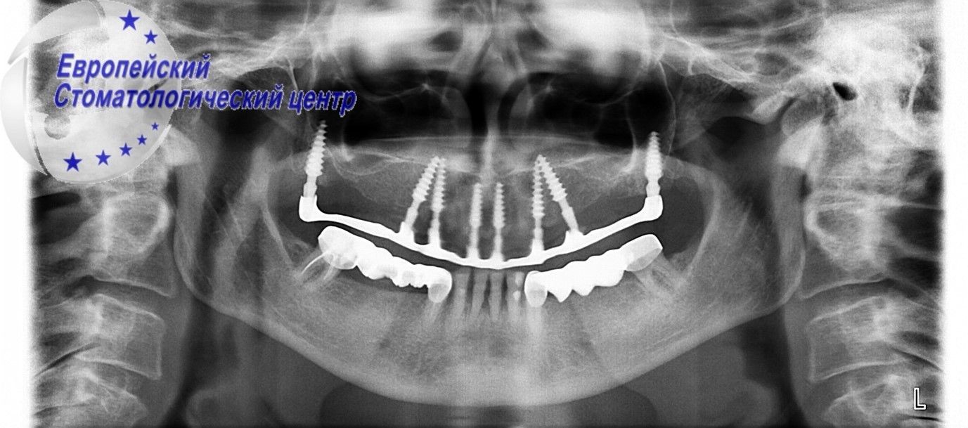 implantacija 8