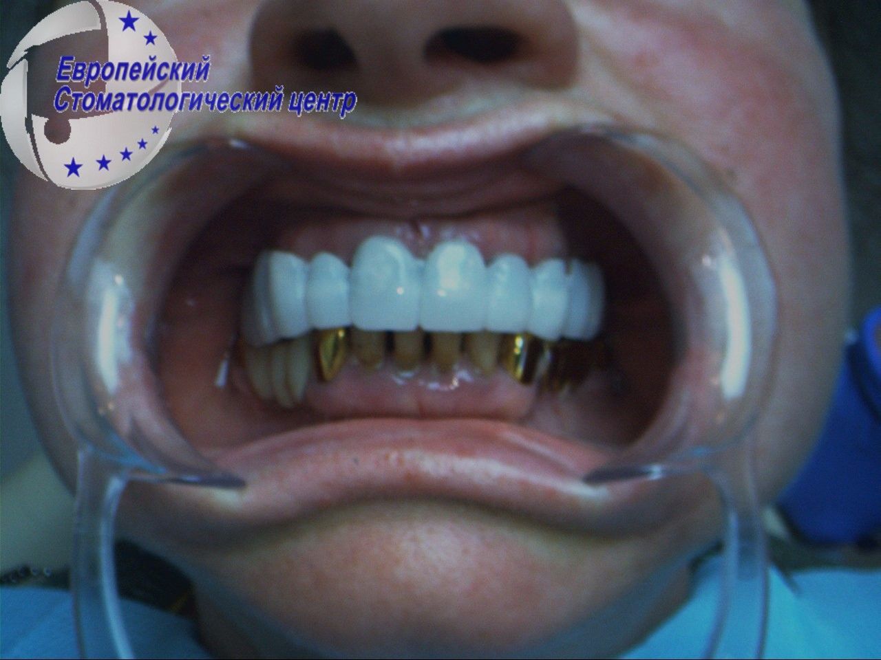 implantacija 9