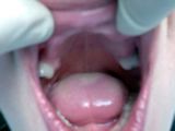 До установки нейлонового зубного протеза
